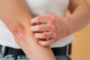 Ayurvedic Psoriasis treatment in Pune | Dr. Manoj Deshpande