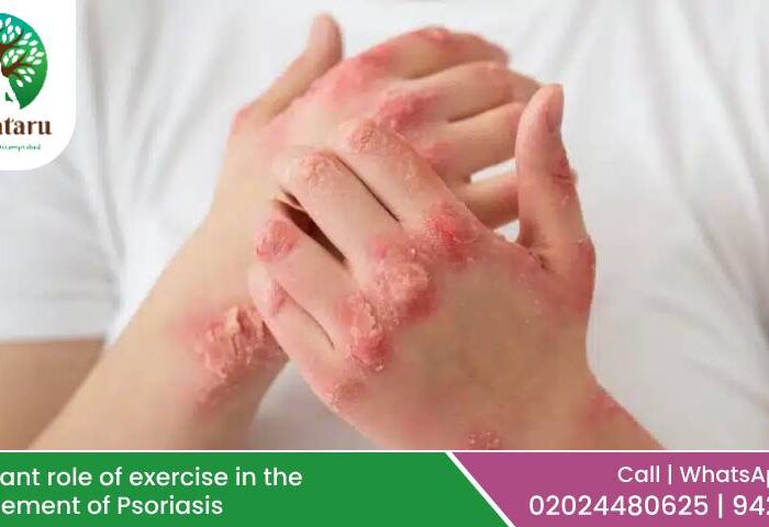 Significant role of exercise in the management of Psoriasis