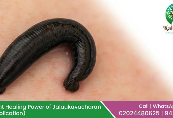 The Ancient Healing Power of Jalaukavacharan (Leech Application)