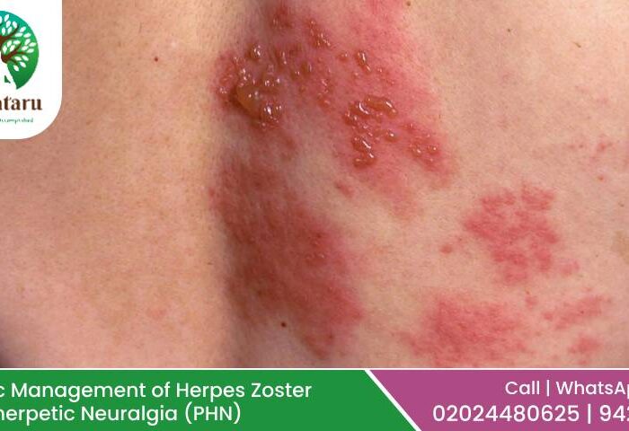 Ayurvedic Management of Herpes Zoster and Postherpetic Neuralgia (PHN)